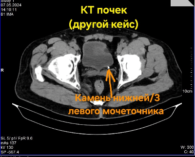 КТ почек
